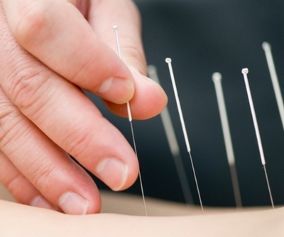 Acupuntura